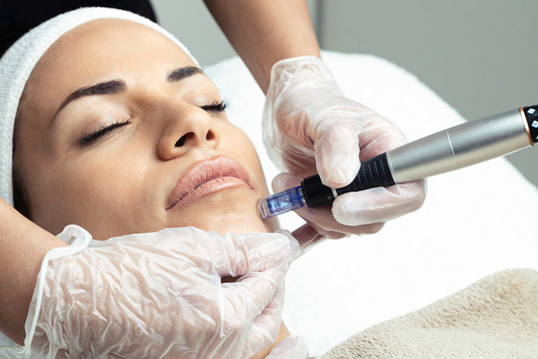 Blog 4 Microneedling